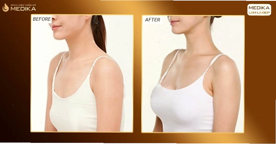 An toàn theo hình ảnh trước sau nâng ngực ở Medika