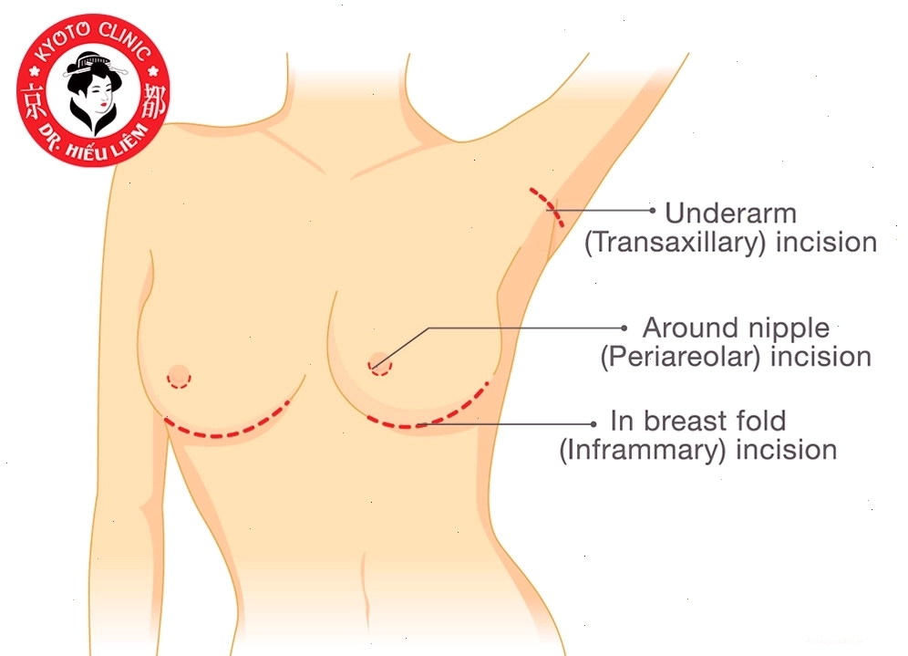 Bác sĩ nâng ngực đường quầng uy tín tại TPHCM