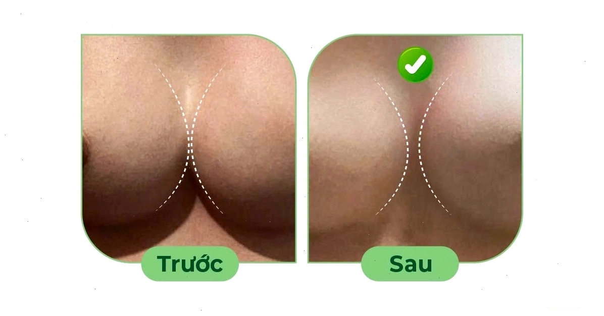 Bác sĩ tư vấn về nguyên nhân ngực thông khe sau nâng ngực