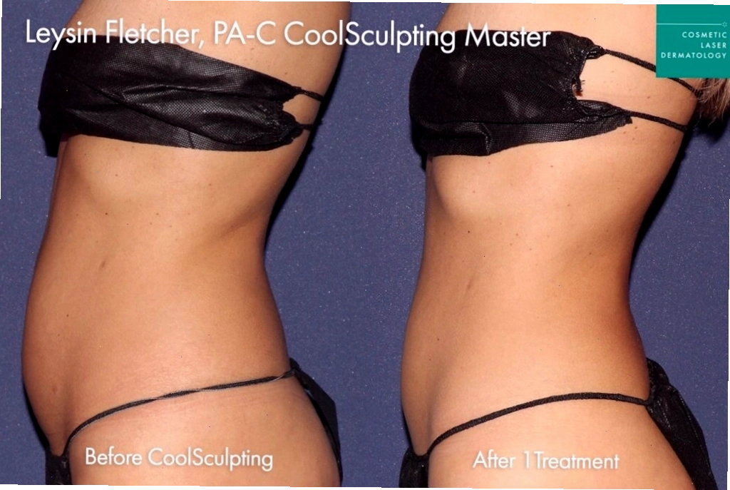 Bệnh nhân nữ trước và sau khi thực hiện CoolSculpting tạo hình cơ thể tại San Diego