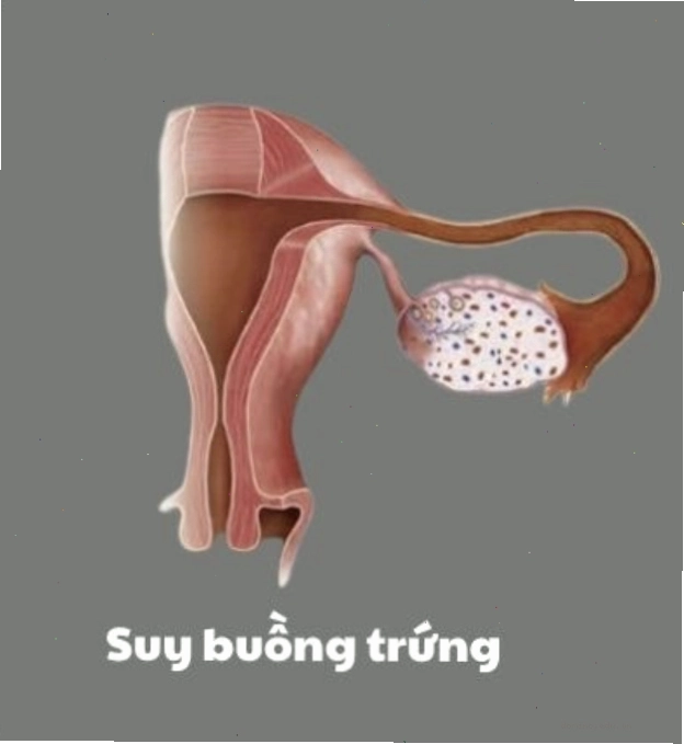 Các bài tập thể dục tốt cho buồng trứng