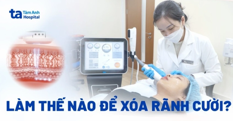 Các cách xóa rãnh cười hiệu quả giúp trẻ hóa khuôn mặt