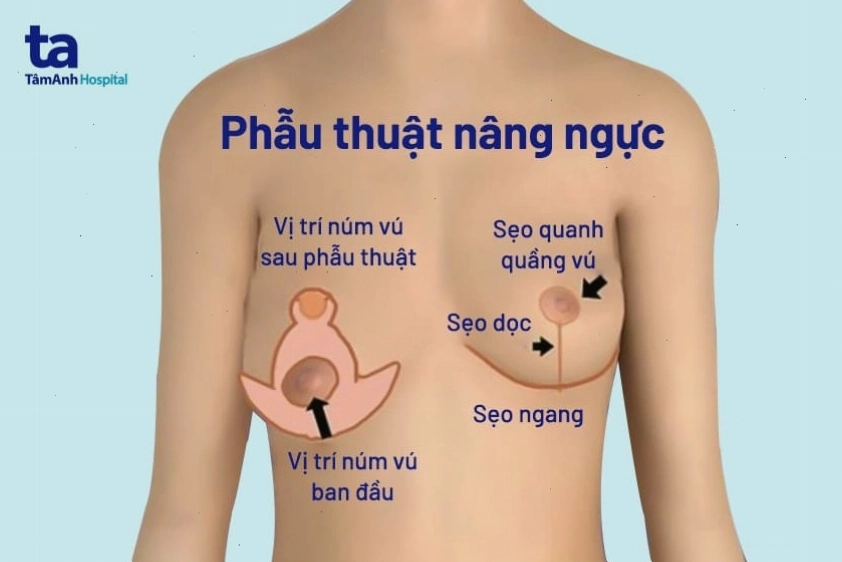 Các phương pháp nâng ngực chảy xệ hiện nay