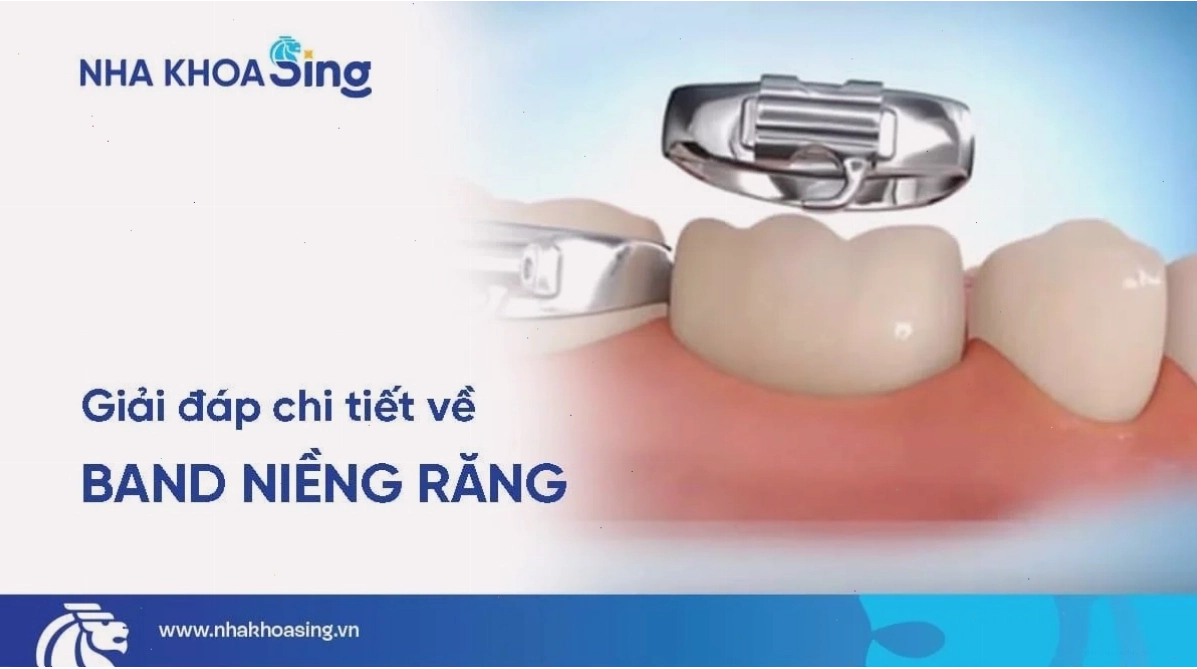 Cận cảnh hàm răng đều đẹp sau khi niềng
