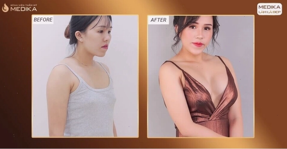 Đánh giá hình ảnh trước sau nâng ngực ở Medika