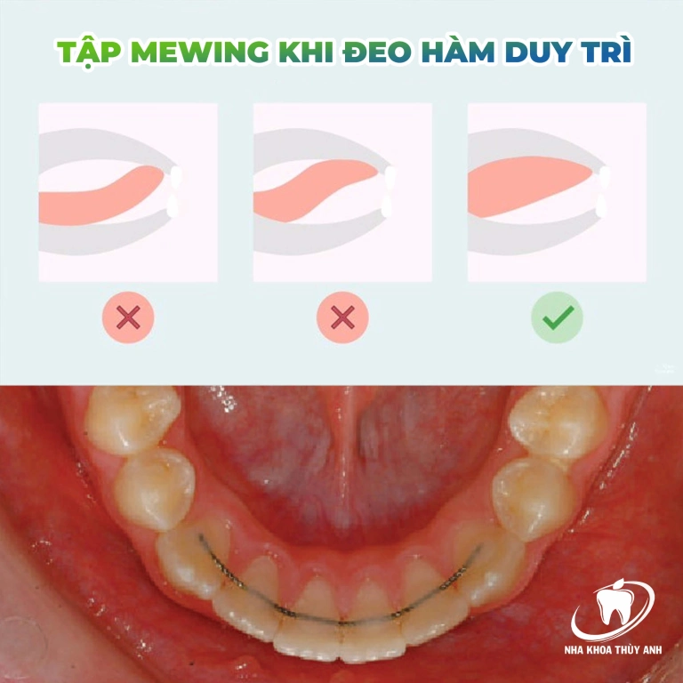 Dụng cụ tập Mewing và những điều cần lưu ý khi kết hợp với hàm duy trì