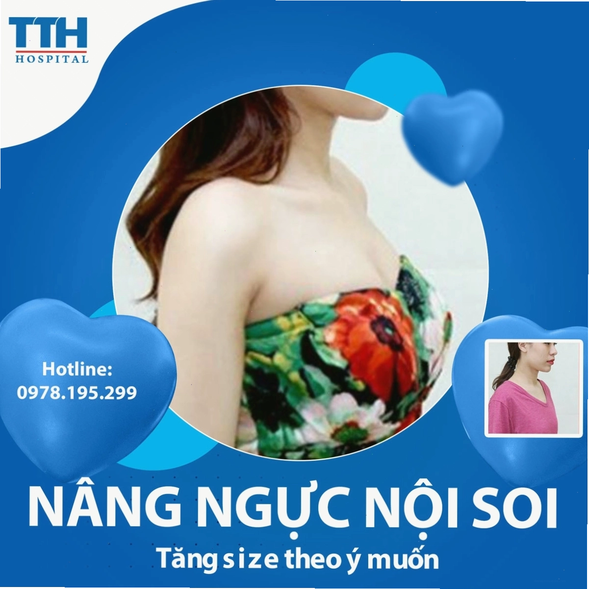 Hình ảnh kết quả nâng ngực thực tế của khách hàng