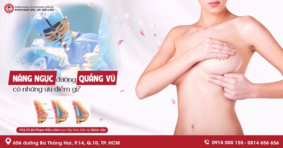 Hình ảnh khách hàng nâng ngực túi độn Motiva Ergonomix
