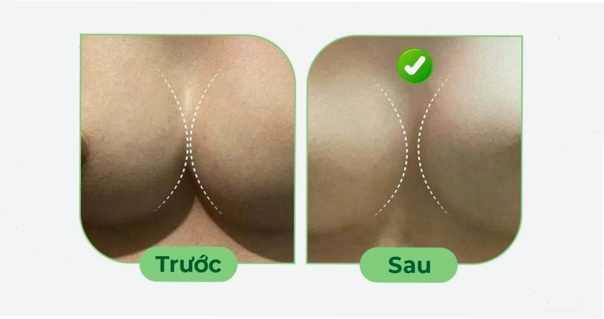 Hình ảnh minh họa điều trị ngực thông khe sau nâng ngực