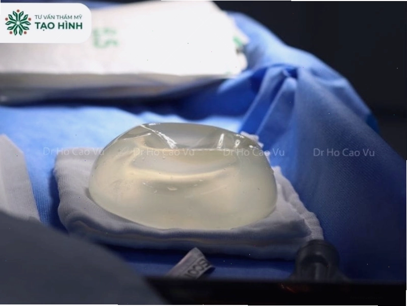 Hình ảnh minh họa tác động tiêu cực của việc nâng ngực sai kích cỡ