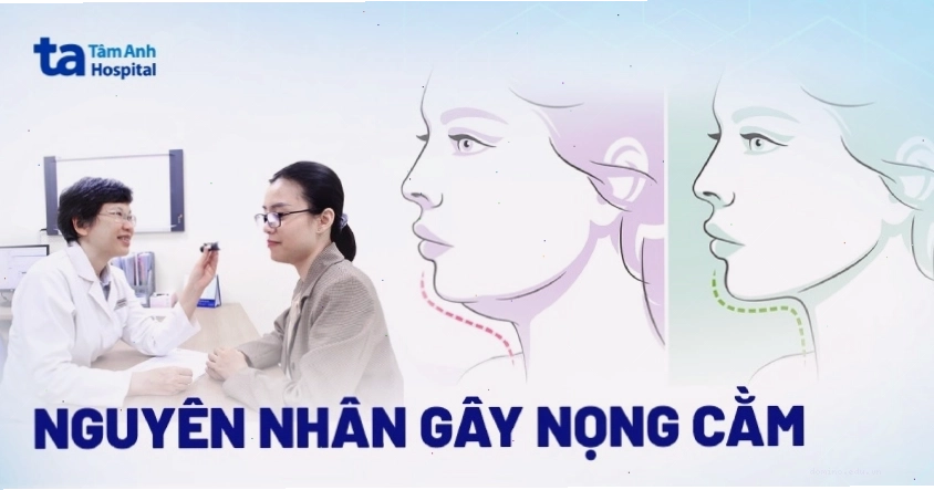 Hình ảnh minh họa tình trạng nọng cằm dưới cằm