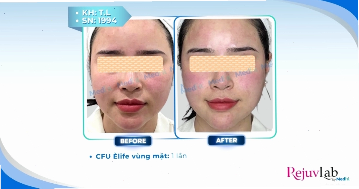 Hình ảnh minh họa về các liệu pháp thẩm mỹ giảm mỡ mặt