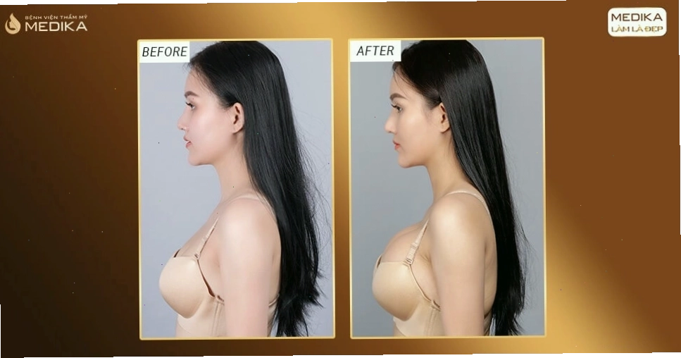 Hình ảnh trước sau khi nâng ngực an toàn và trả góp ở Medika