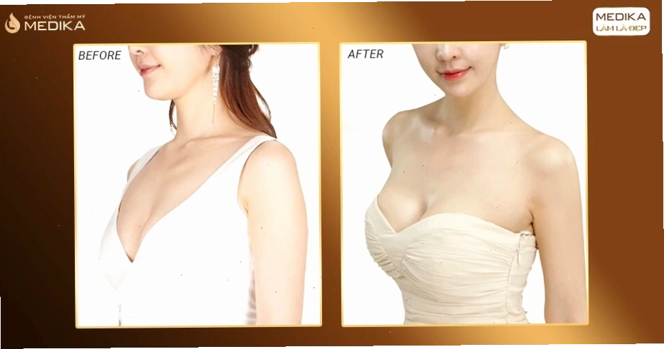 Hình ảnh trước sau nâng ngực ở Medika như diễn viên Hàn Quốc