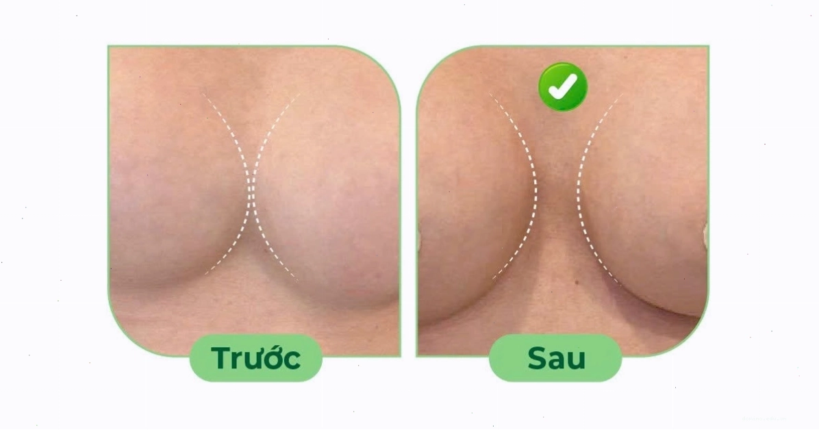 Hình ảnh trước và sau khi nâng ngực tạo khe MEDIKA