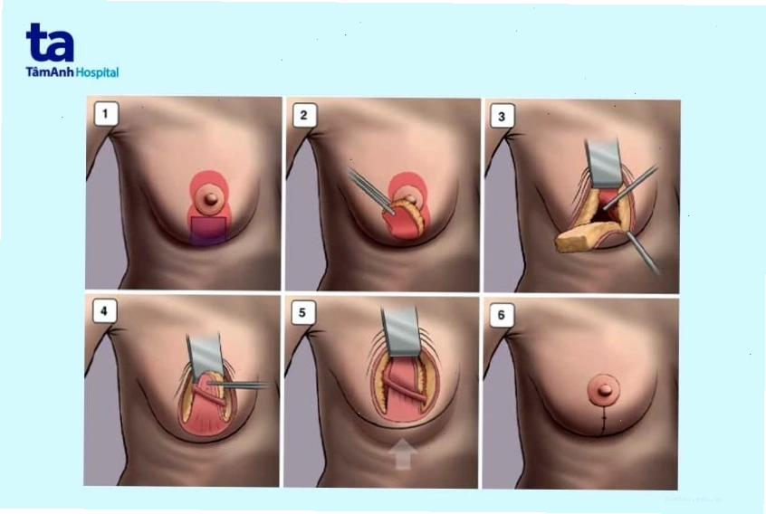 Hướng dẫn chăm sóc sau phẫu thuật nâng ngực chảy xệ