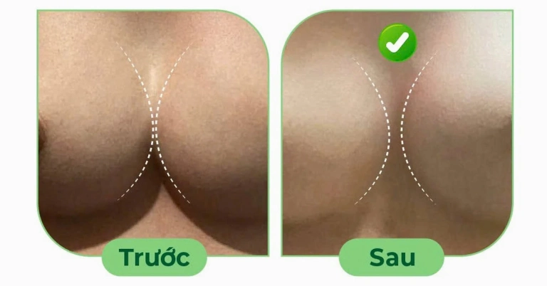 Khắc phục tình trạng khe ngực rộng sau nâng ngực và các giải pháp hiệu quả