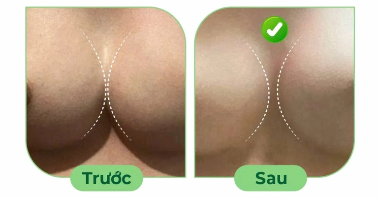 Khắc phục tình trạng ngực xa nhau: Giải pháp toàn diện từ chuyên gia