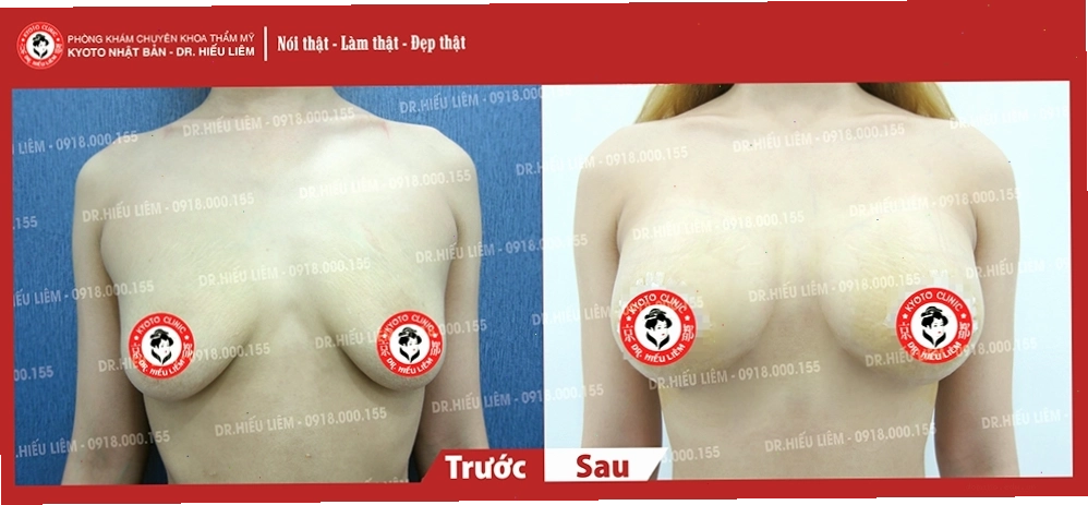 Khách hàng sau nâng ngực giọt nước