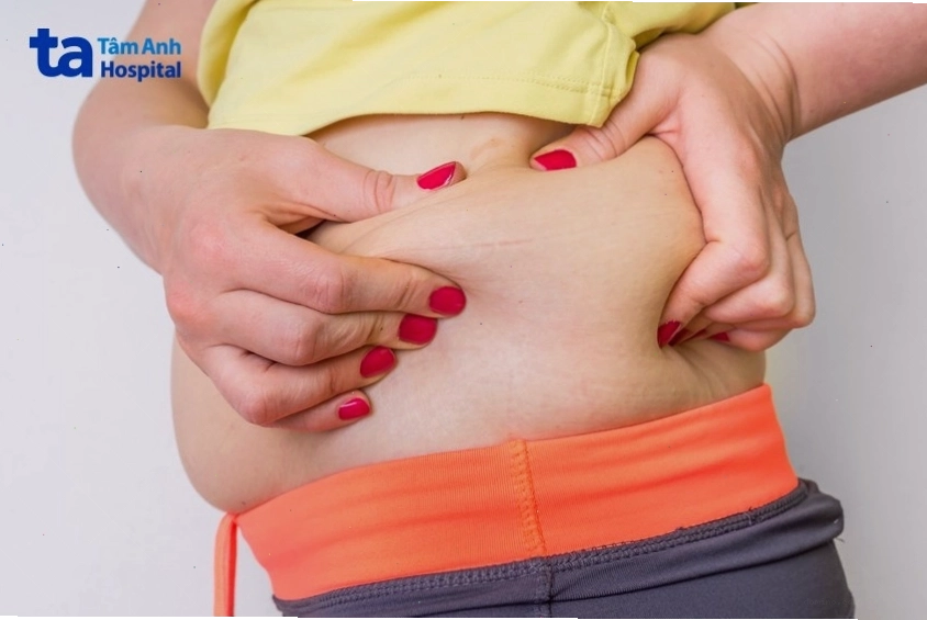 Minh họa các nguyên nhân phổ biến gây tích mỡ ở vùng eo và hông