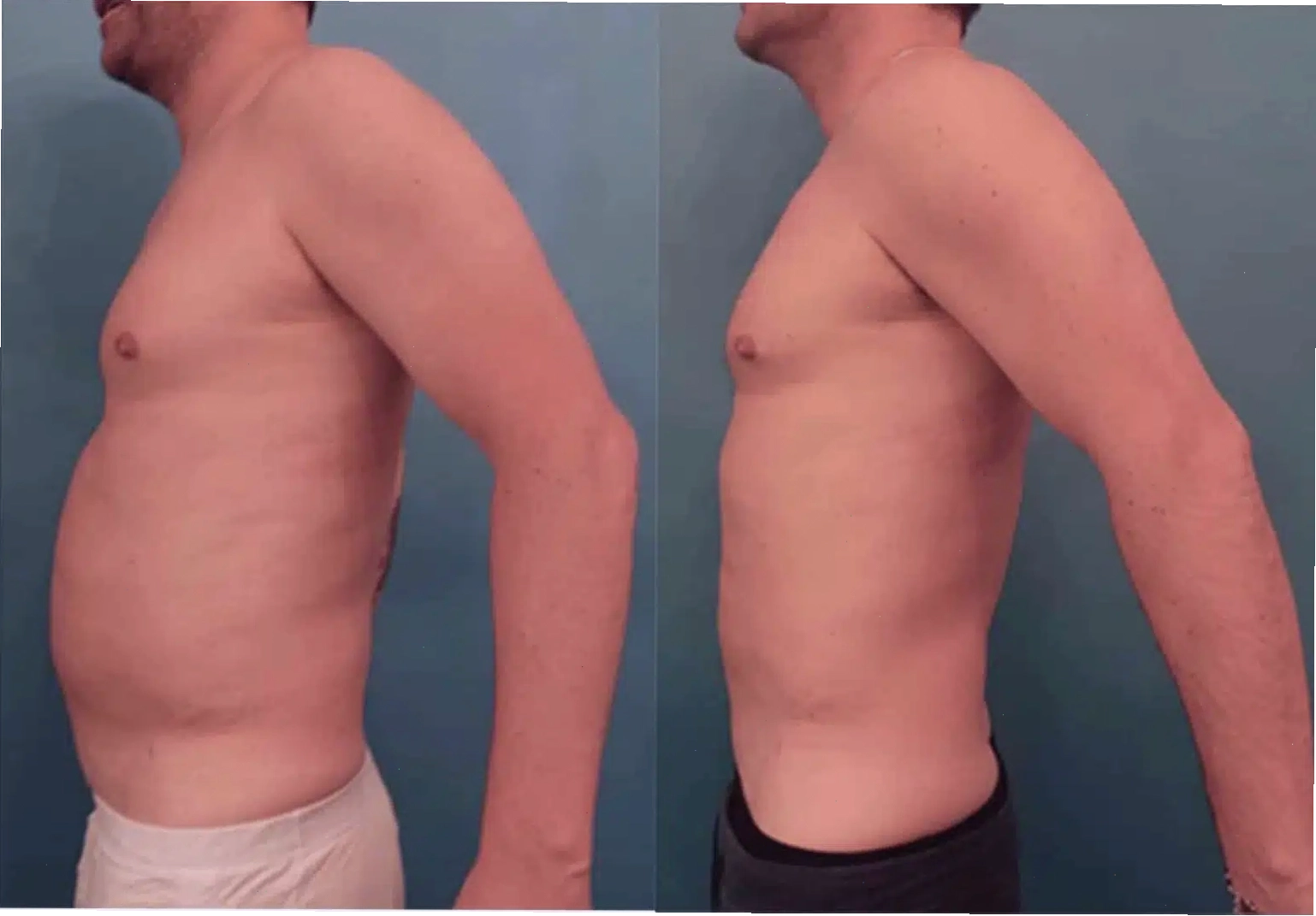 Minh họa công nghệ body contouring không xâm lấn cho vùng eo