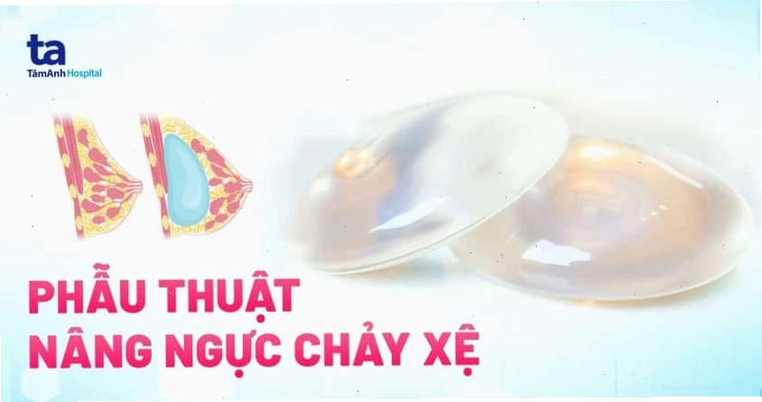 Minh họa quy trình phẫu thuật nâng ngực chảy xệ