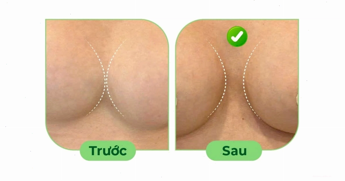 Minh họa sai chỉ định giải phẫu trong phẫu thuật nâng ngực