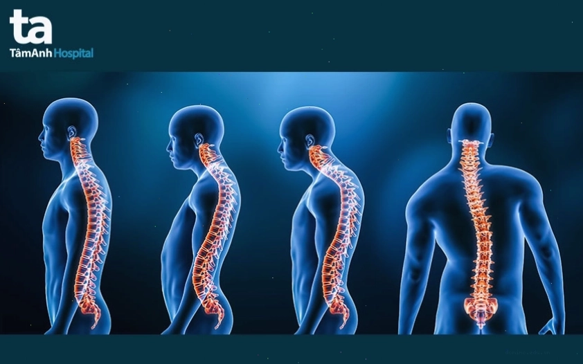 Minh họa tình trạng gù lưng ảnh hưởng đến vóc dáng và sức khỏe tổng thể