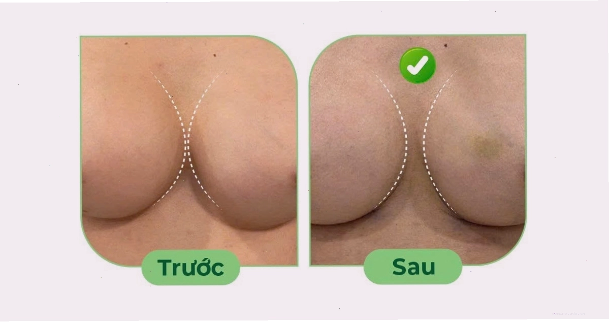 Minh họa túi ngực quá lớn so với cơ thể gây biến chứng nâng ngực