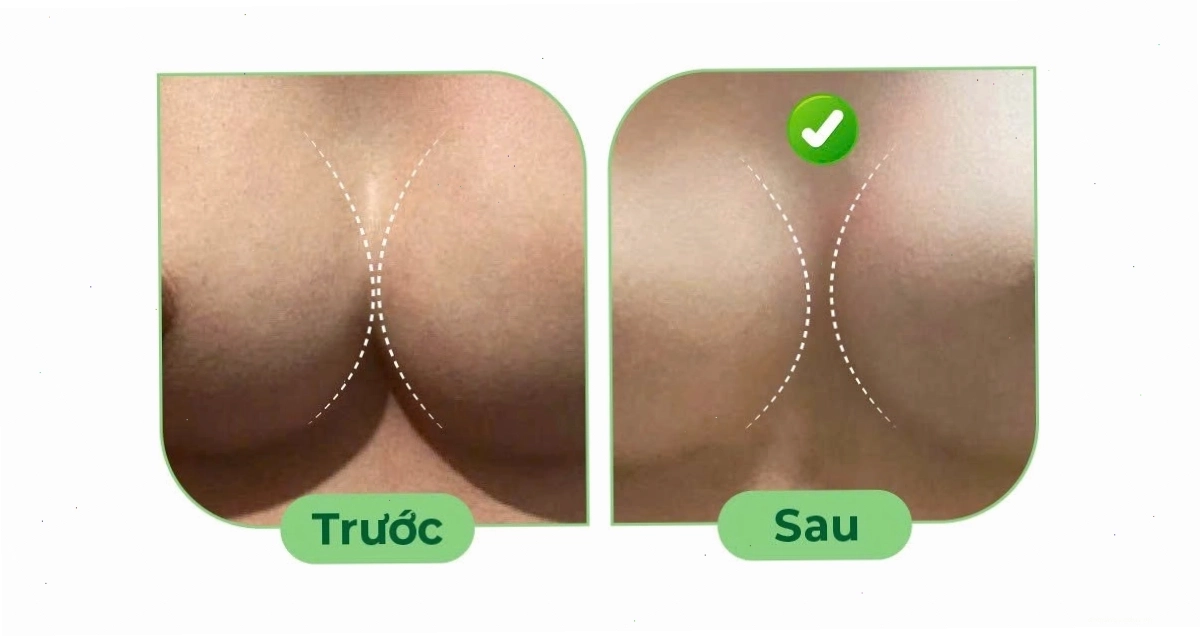 Minh họa việc mặc sai áo định hình gây ảnh hưởng đến kết quả nâng ngực