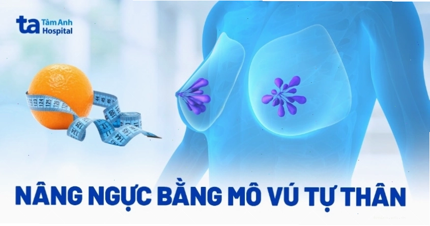 Nâng ngực bằng mô vú tự thân
