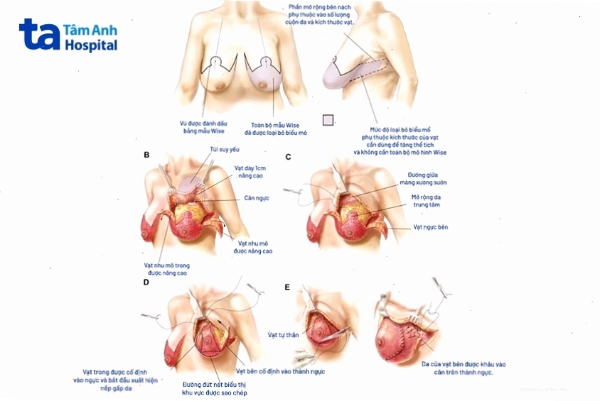 Nâng ngực bằng vạt mô