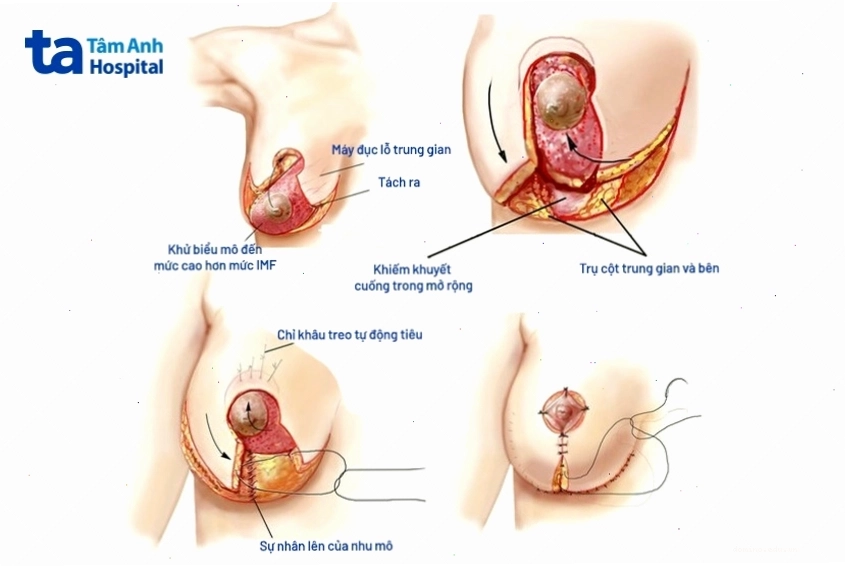 Nâng ngực bằng vạt tự thân