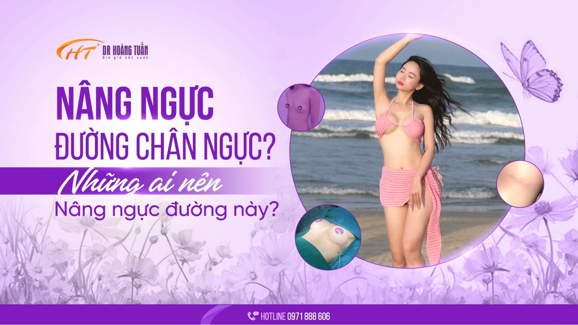 Nâng ngực đường quầng giúp bầu ngực đẹp tự nhiên và cân đối