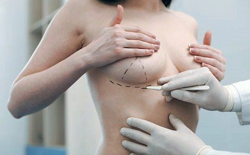 Nâng ngực đường quầng là gì? Ưu nhược điểm và đối tượng phù hợp