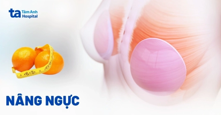 Nâng ngực thẩm mỹ bí quyết sở hữu vòng một quyến rũ năm 2026