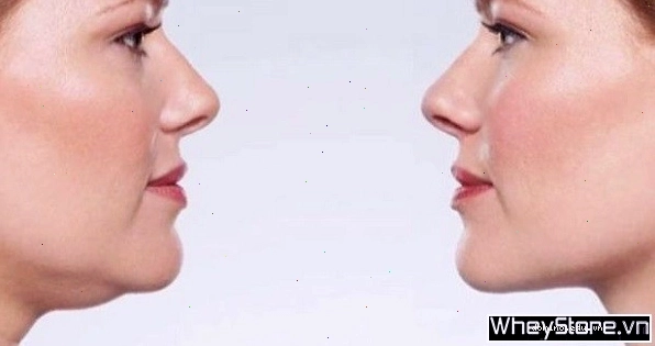 Nguyên nhân gây nọng cằm do thừa cân và lão hóa da