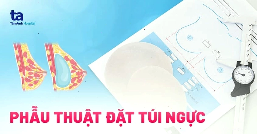 Phẫu thuật đặt túi ngực giúp cải thiện thẩm mỹ vòng một