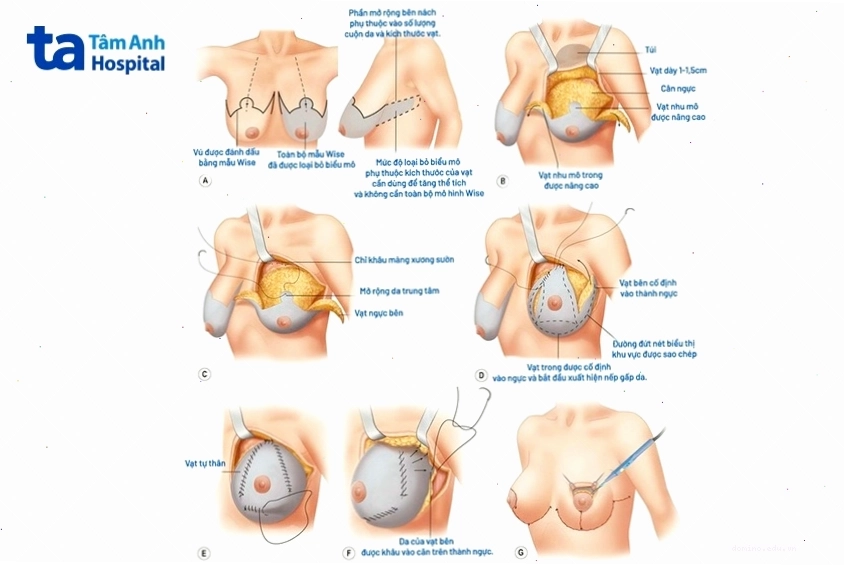 Phẫu thuật nâng ngực bằng mô vú tự thân