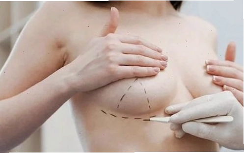 Phẫu thuật nâng ngực giúp cải thiện hình dáng, kích thước và độ săn chắc của vòng 1