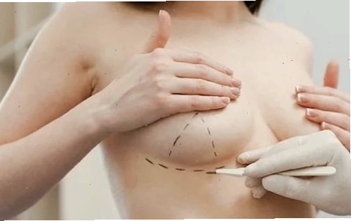 Phẫu thuật nâng ngực là phương pháp làm đẹp giúp cải thiện hình dáng, kích thước và độ săn chắc của vòng 1
