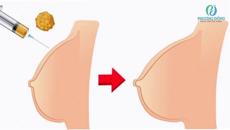 Quy trình tăng kích thích vòng 1 bằng mô mỡ tự thân