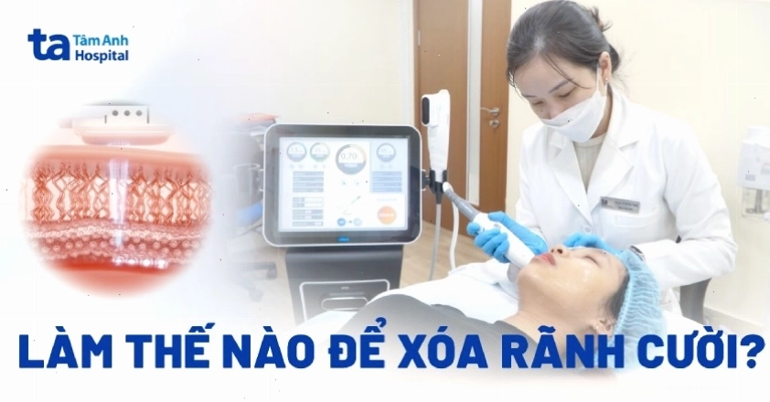 Quy trình xóa rãnh cười bằng công nghệ tiên tiến