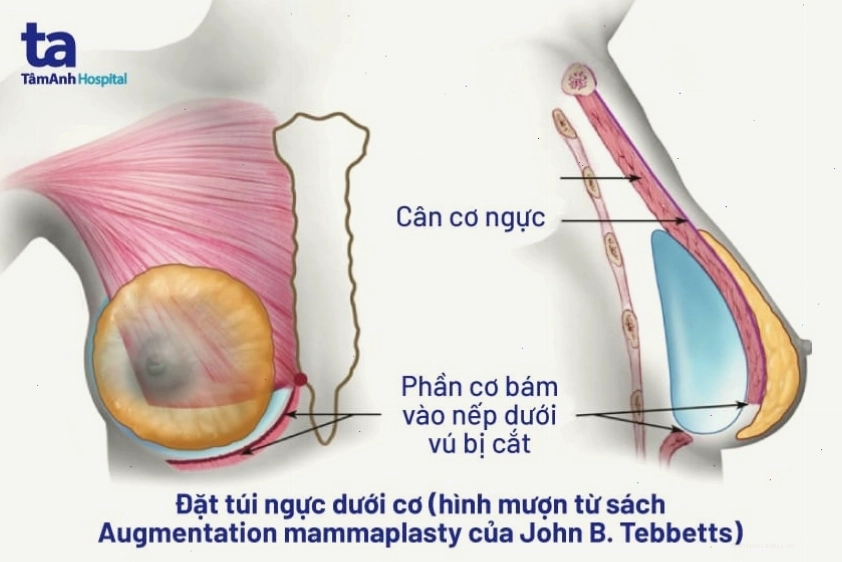 Sơ đồ các vị trí đặt túi ngực dưới cơ