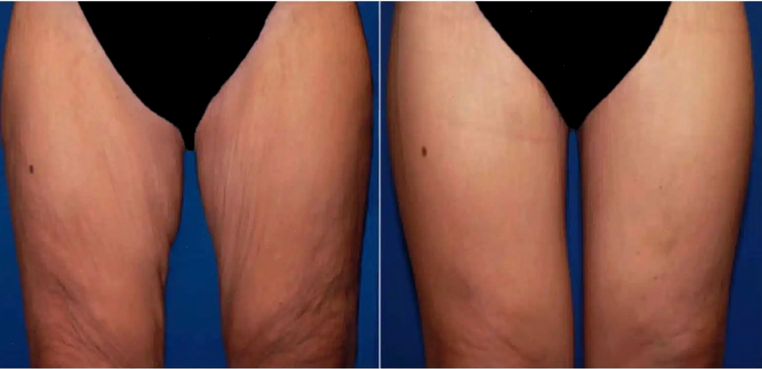 So sánh hiệu quả body contouring trước và sau