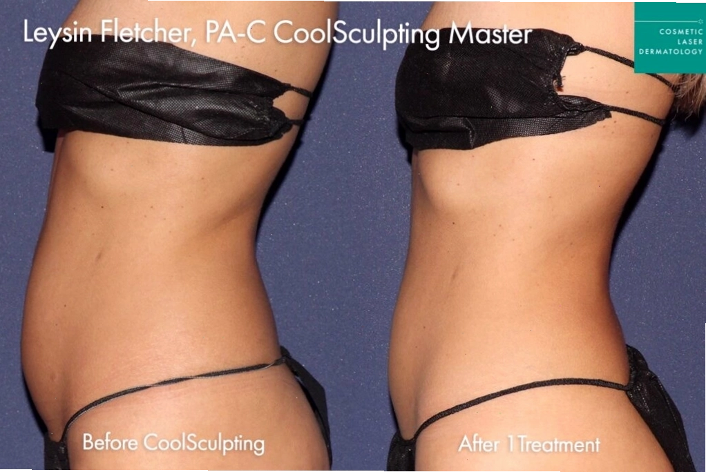 So sánh trước và sau khi điều trị CoolSculpting để tạo hình cơ thể