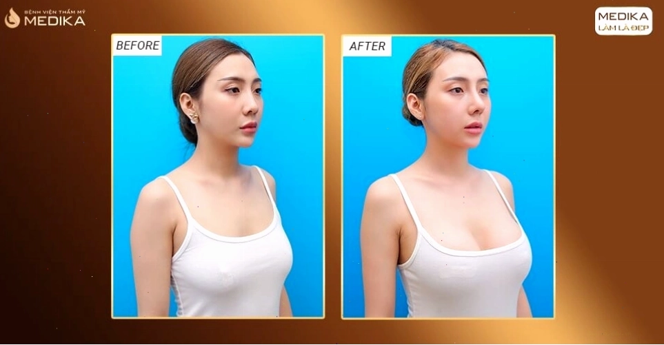 So sánh túi ngực giọt nước và túi ngực tròn