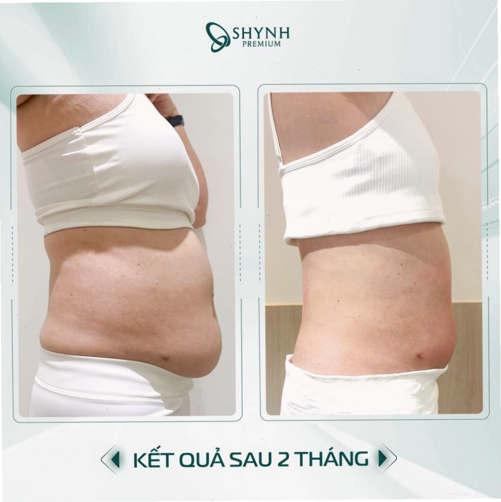 Sự thay đổi của khách hàng Shynh Premium sau phác đồ giảm mỡ