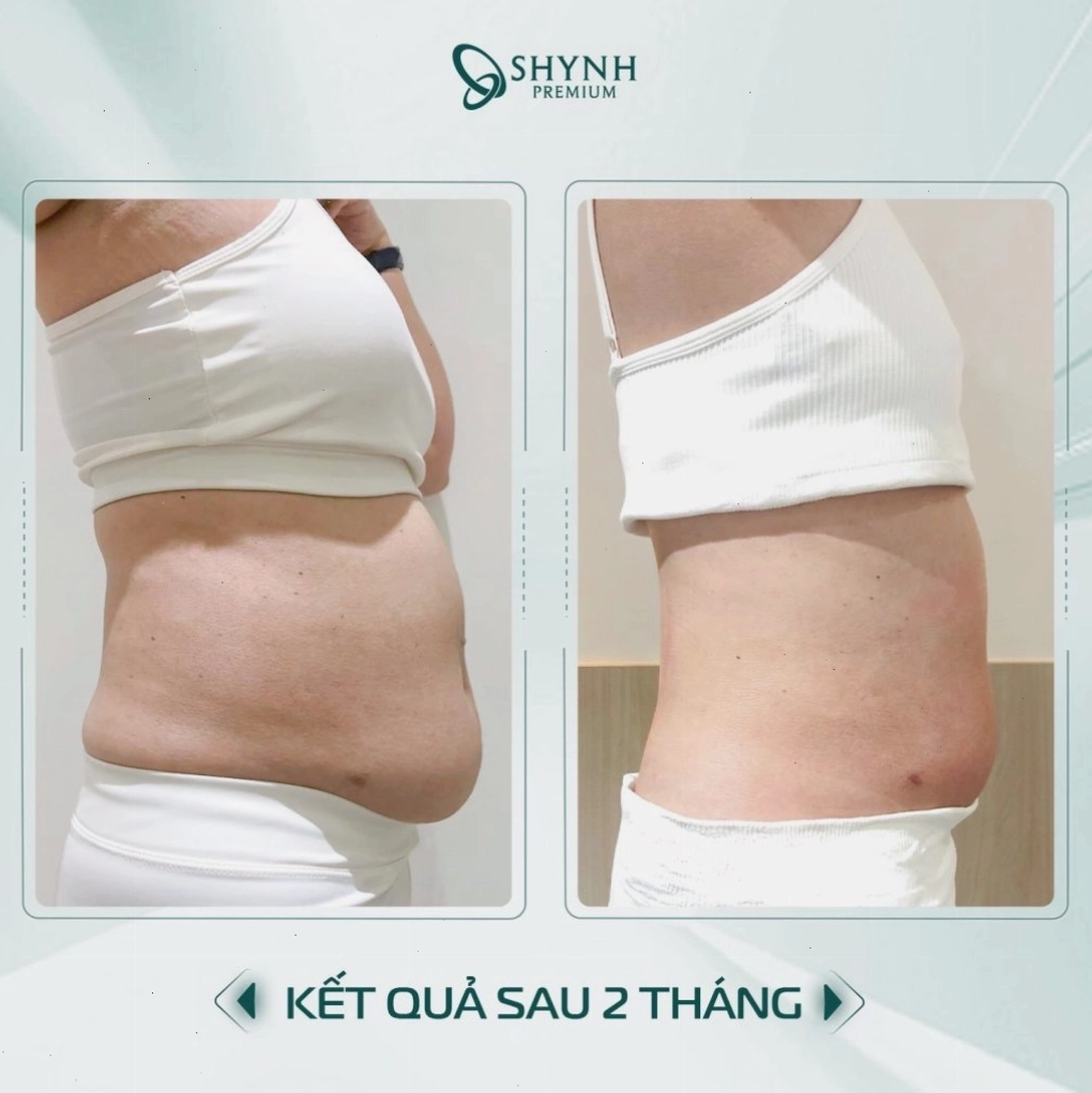 Sự thay đổi của khách hàng Shynh Premium sau phác đồ giảm mỡ
