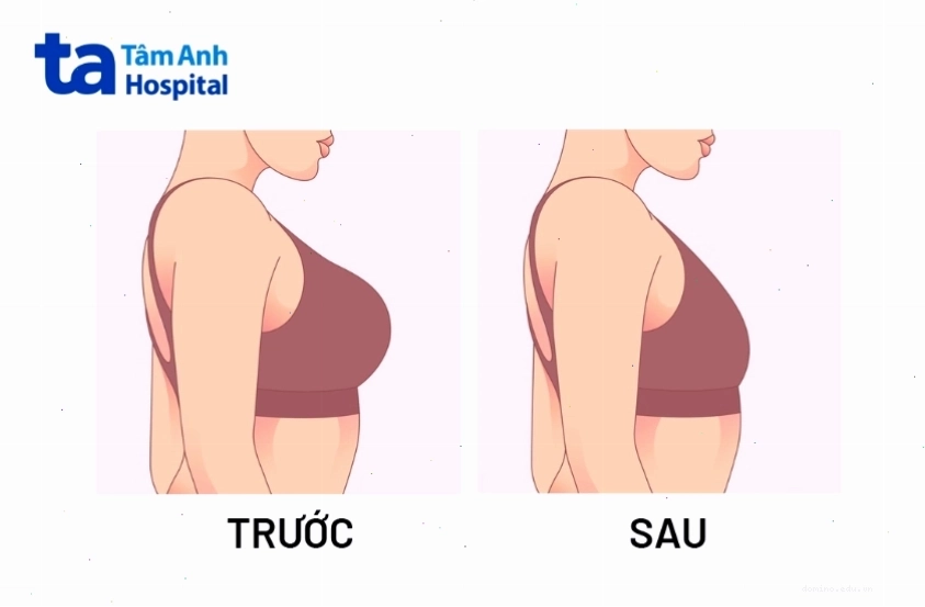 Tập chống đẩy giúp làm săn chắc cơ ngực